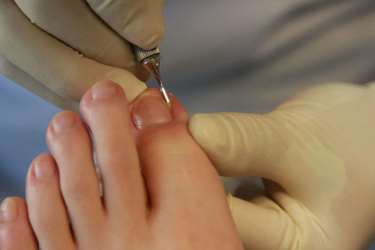 Tratamiento profesional de hongos en uñas